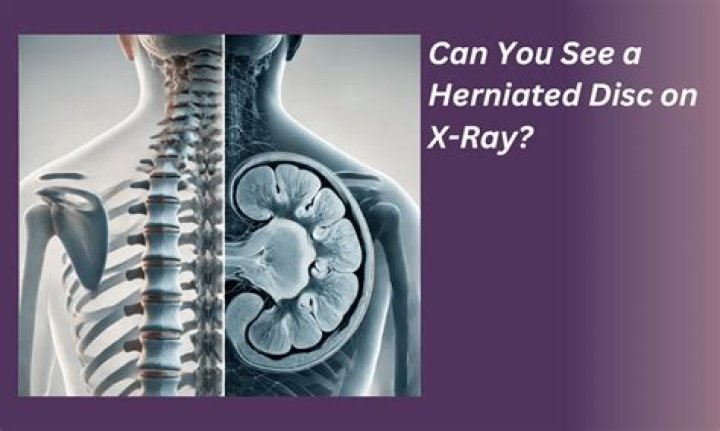 What Challenges Are Posed By Trying To See A Herniated Disc On An X-Ray?