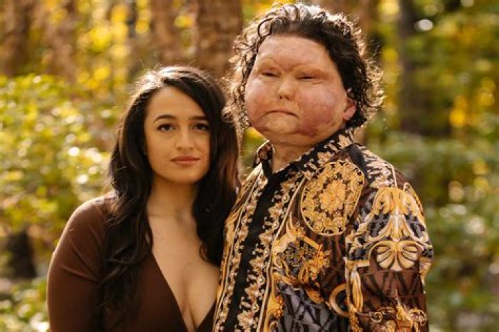 Youngest US face transplant recipient shares story of suicide survival and hope: 'Life is an amazing gift'